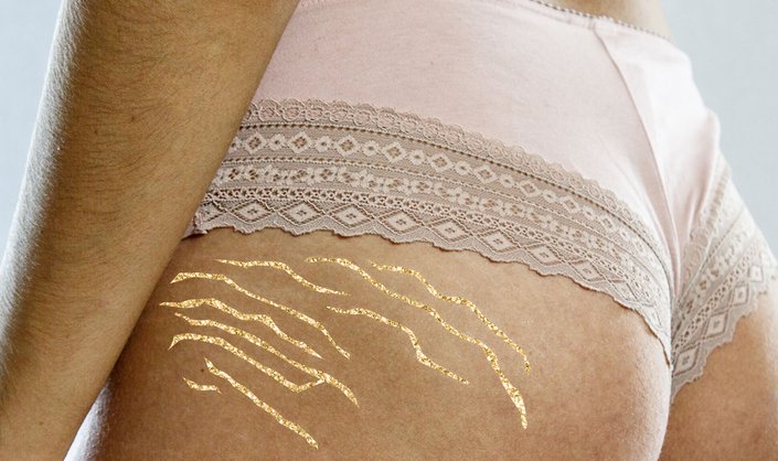 Stretch Marks: Causes, Treatment, And Prevention