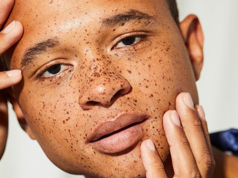 How to Tell If You Have a Mole, Birthmark or Freckle